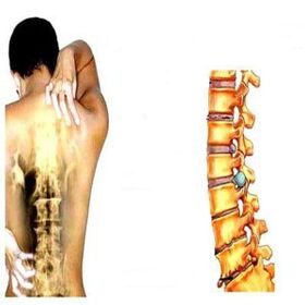 Osteokondrosiaren faseak