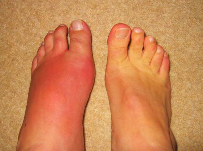 hanka artikulazioetan mina gota dela eta